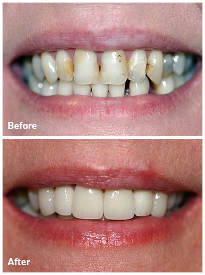 before and after photos of porcelain crowns