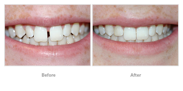 clear orthodontics before and after photos